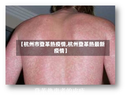 【杭州市登革热疫情,杭州登革热最新疫情】-第2张图片